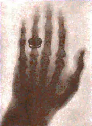 Photographic film of Röntgen’s wife, Bertha's hand with a ring, produced on Friday, November 8, 1895.